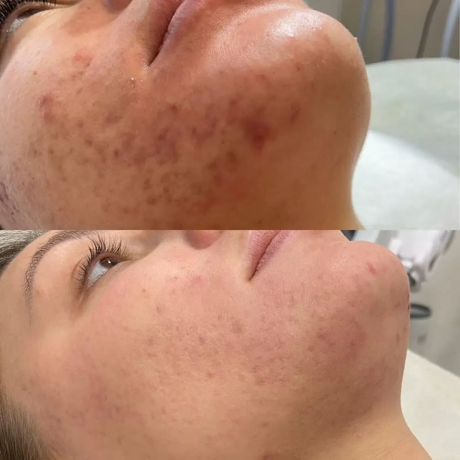 Щека и подбородок с акне до (сверху) и после (снизу) курса процедур в Viva Clinic